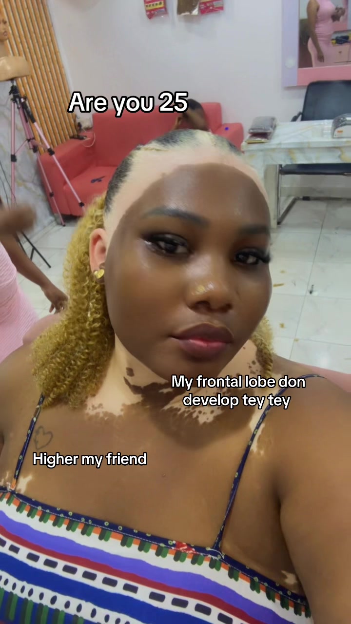 @Thevitiligogirl