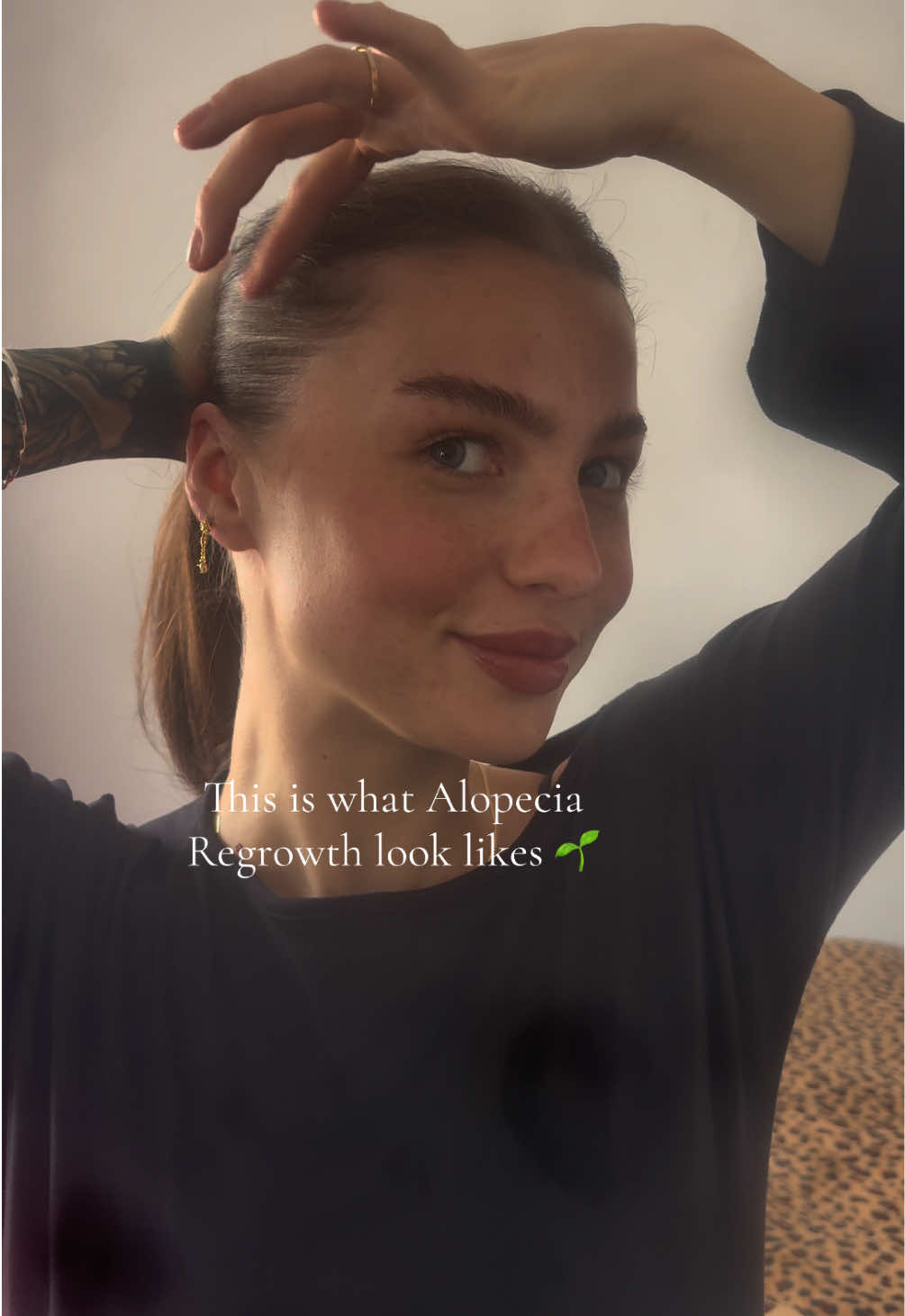 @Brooke💗Hair loss Journey