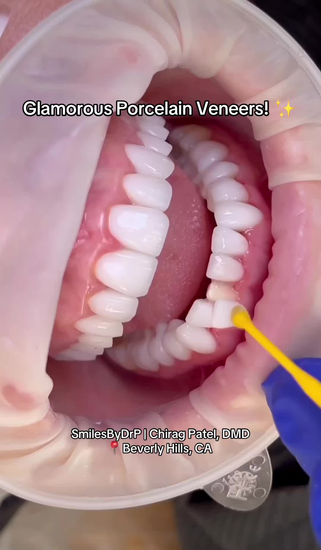 @Veneers