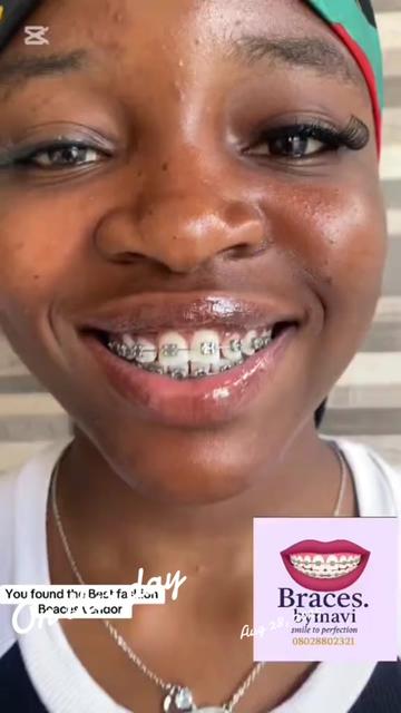@Braces.bymavi|Smile Aesthetics