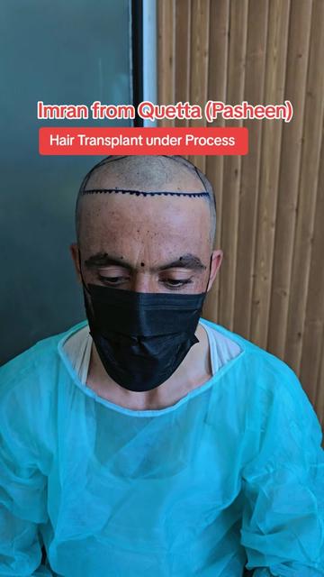 @Dr Asad shalman HairTransplant