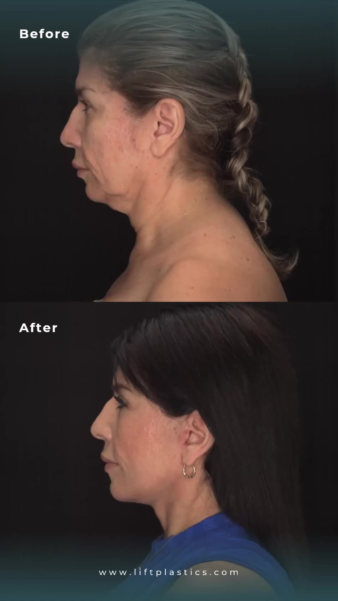 @Lift Plastic Surgery