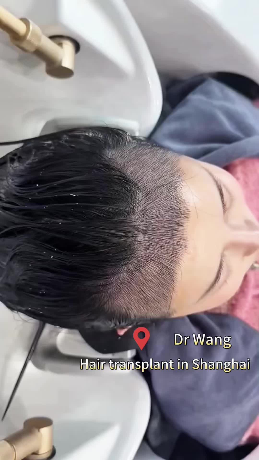 @HAIR TRANSPLANT WANG🇨🇳