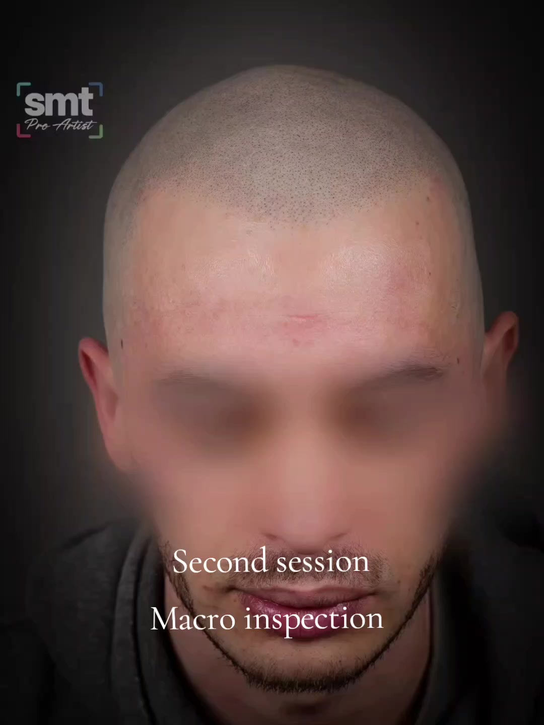 @Enhanced Scalp