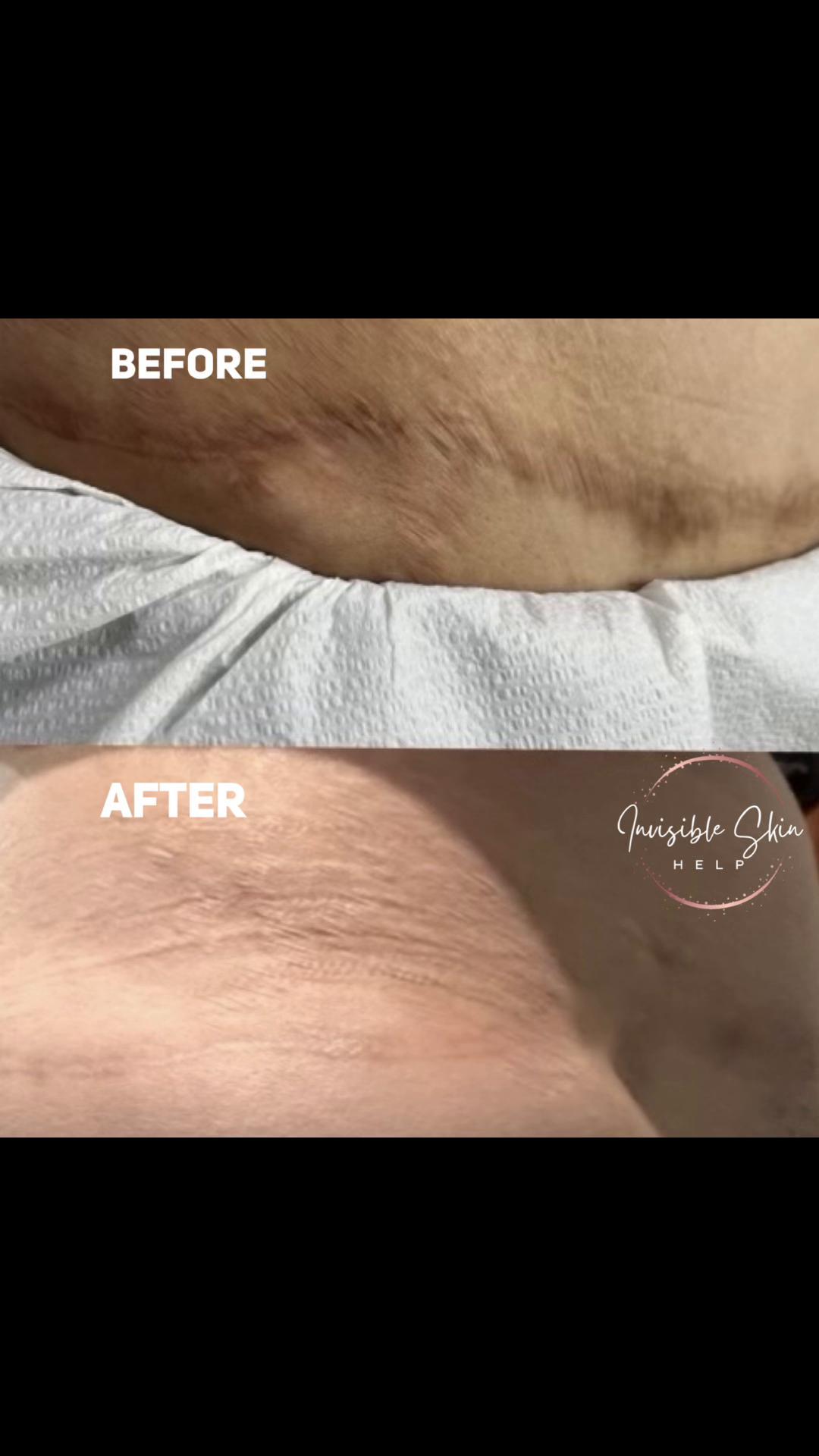 @Invisibleskinhelp