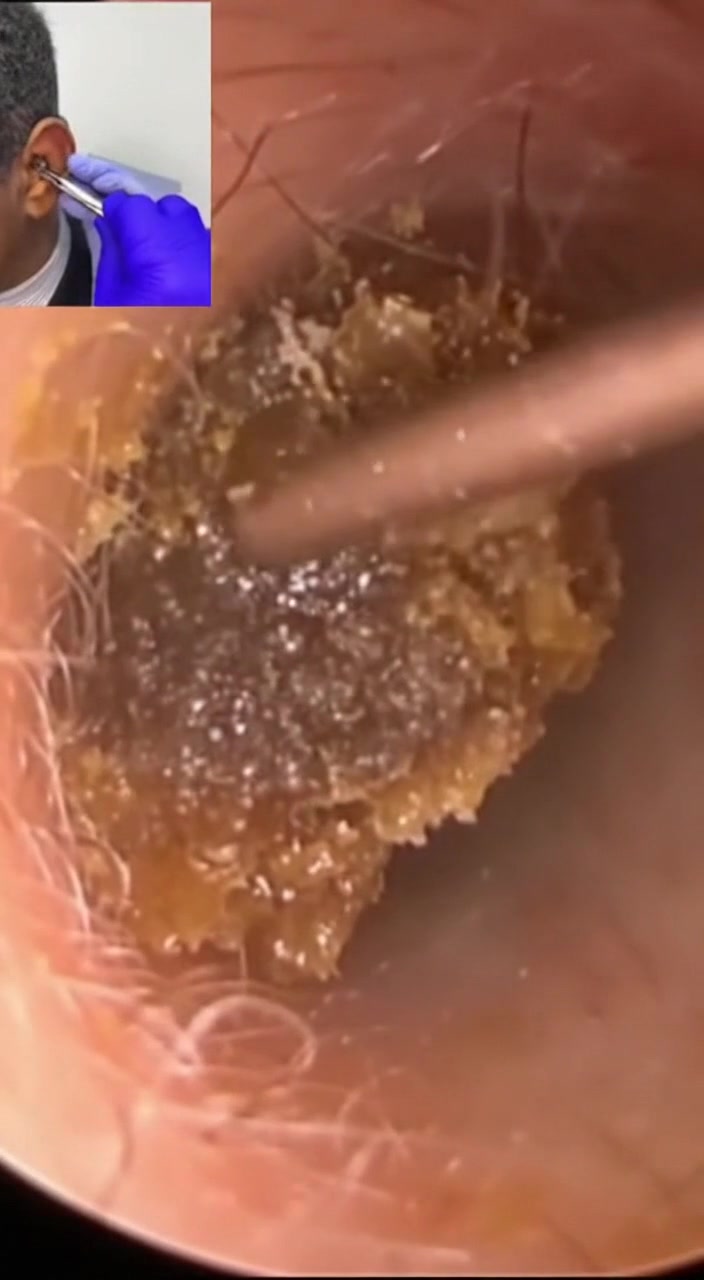 @Ear Cleaning