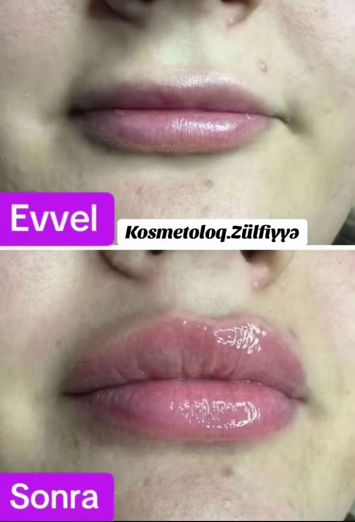 @Xankəndi.Şuşa.💉Kosmetoloq💉
