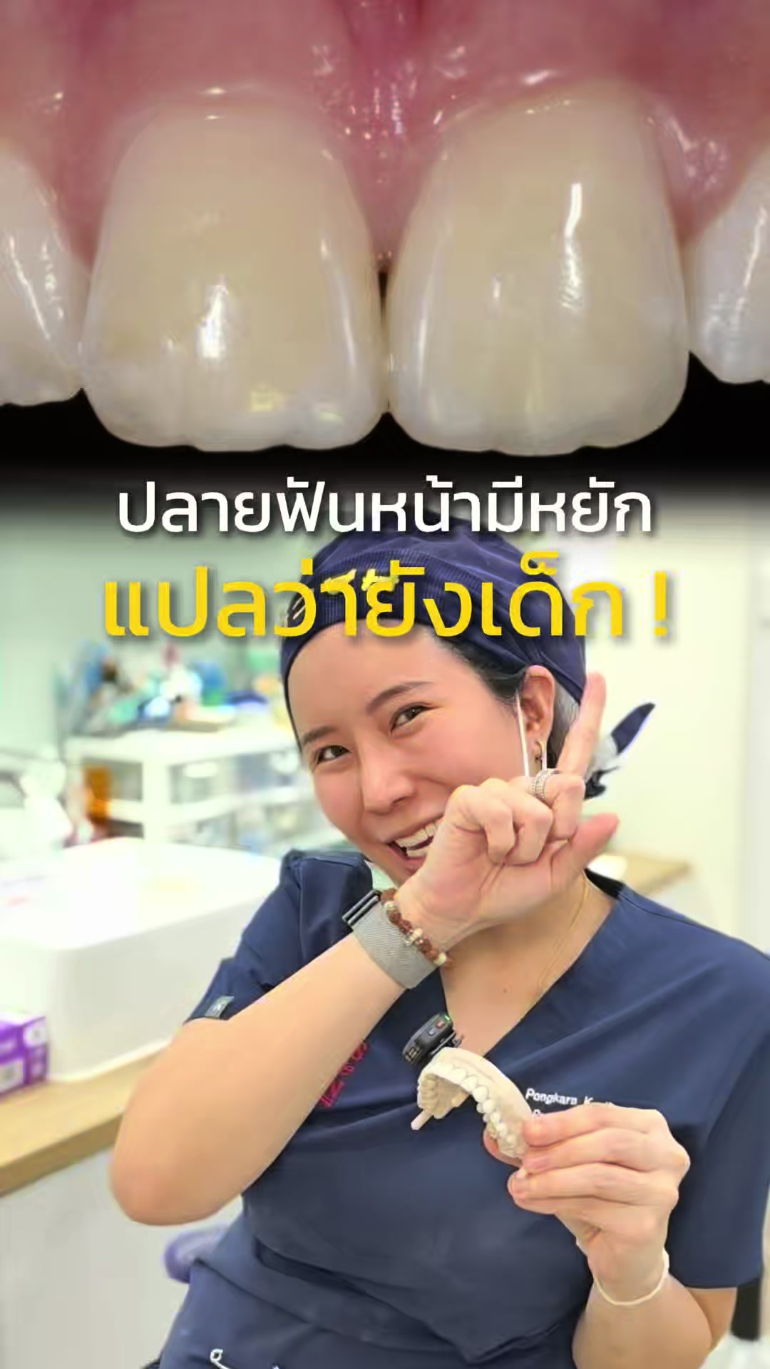 @หมอป่องสวยมาก veneer 🦷