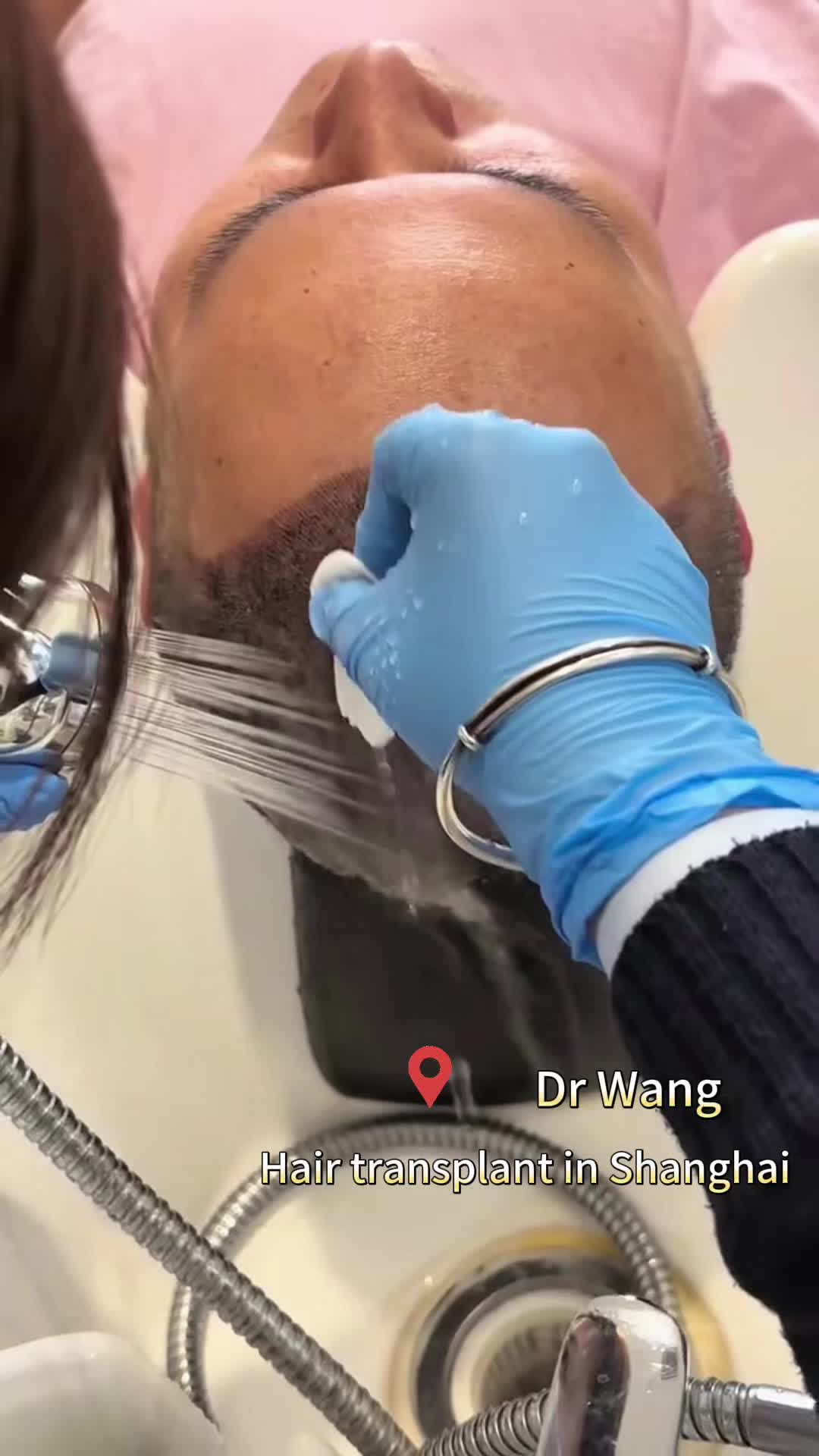 @HAIR TRANSPLANT WANG🇨🇳