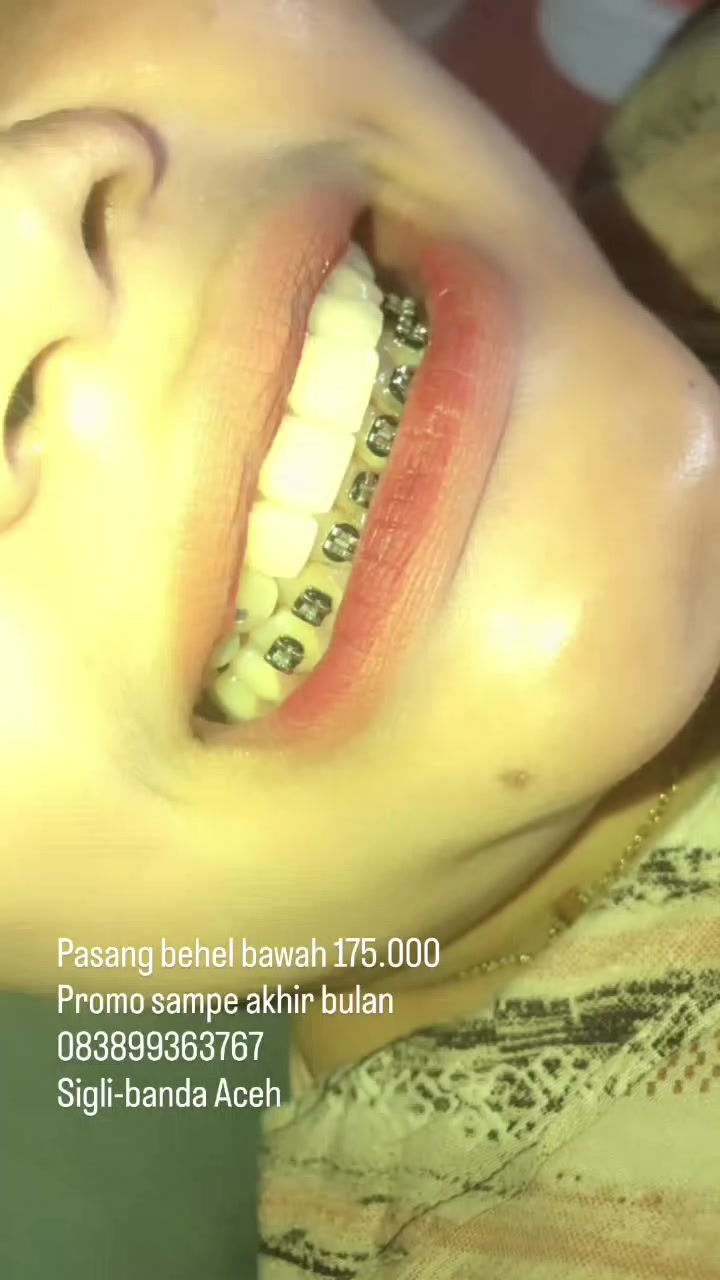 @Eka Eylash dan Behel gigi
