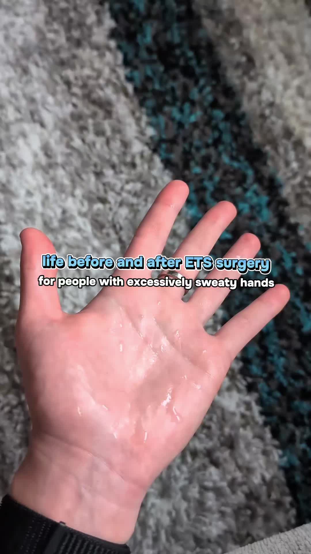 @The Center for Hyperhidrosis