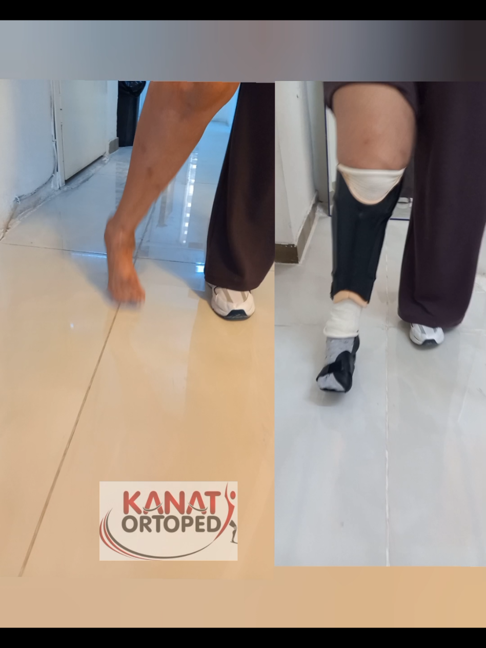 @KanatOrtopedi