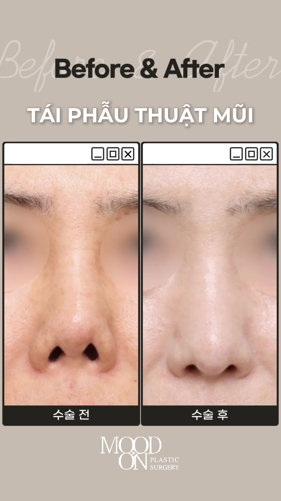 @Bệnh viện thẩm mỹ Mood On