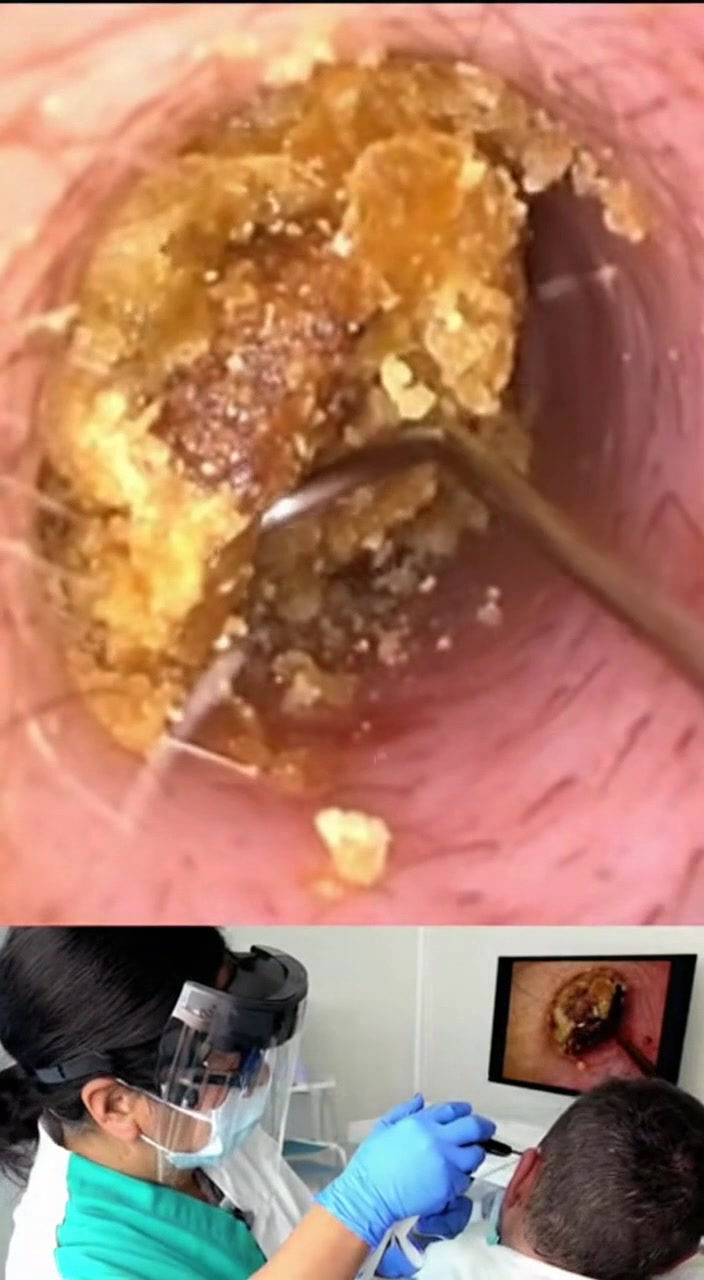 @Ear Cleaning