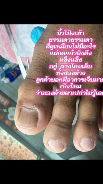 @เล็บขบหาดใหญ่byจิ๊บ
