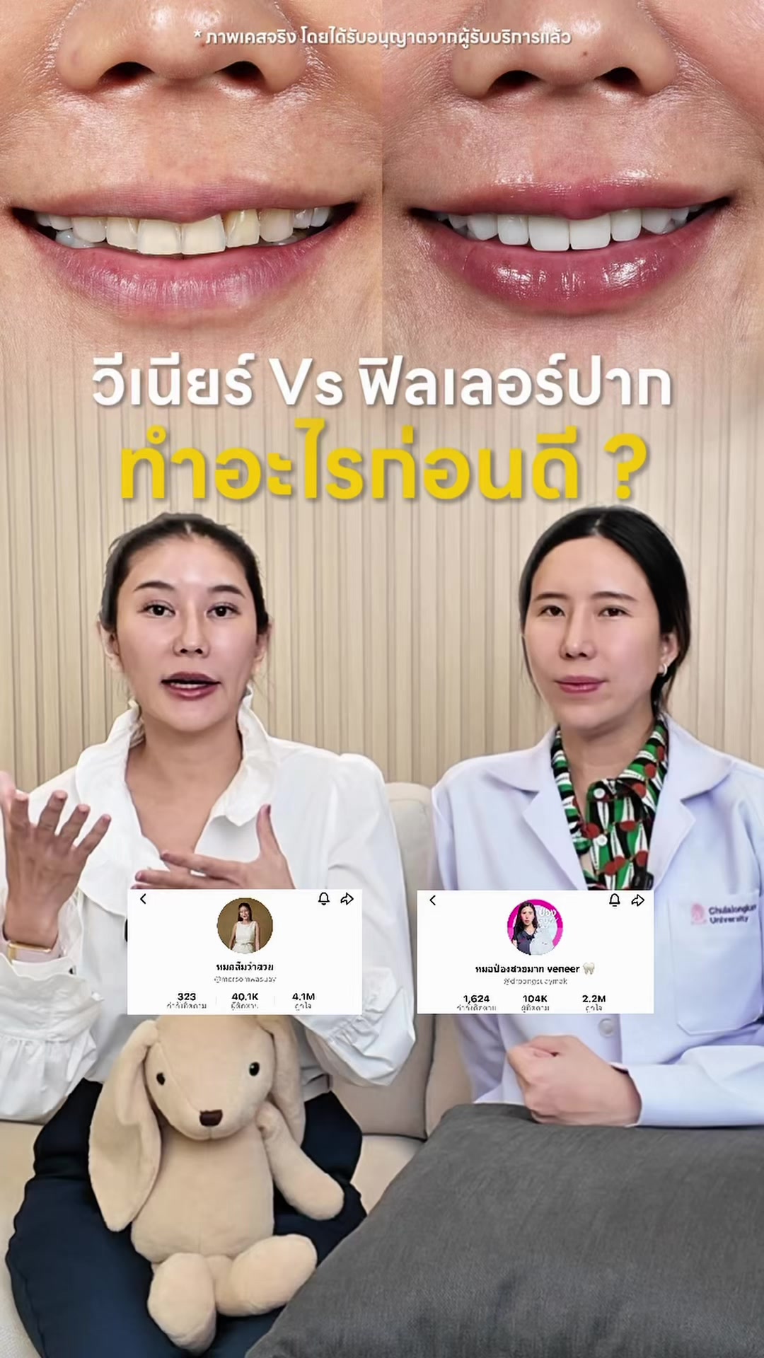 @หมอป่องสวยมาก veneer 🦷