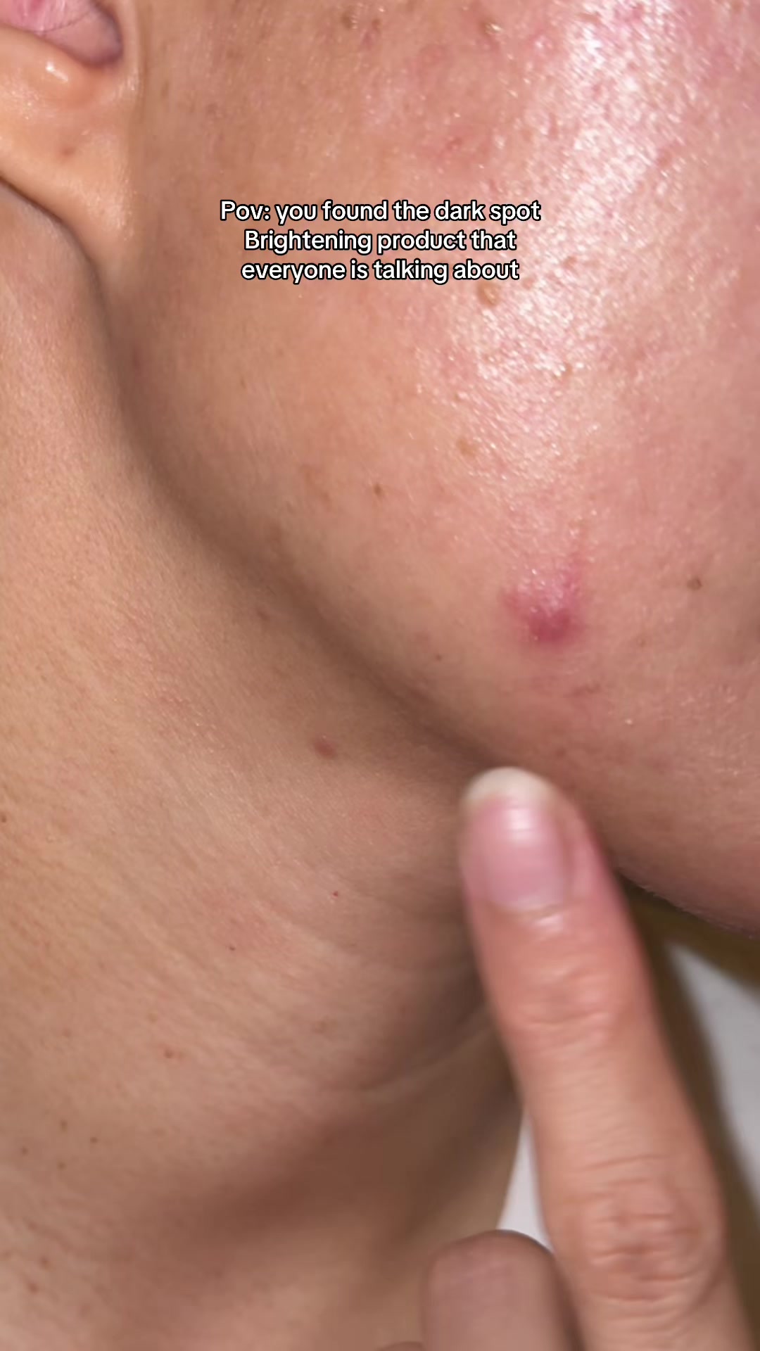 @storyofanacnefighter