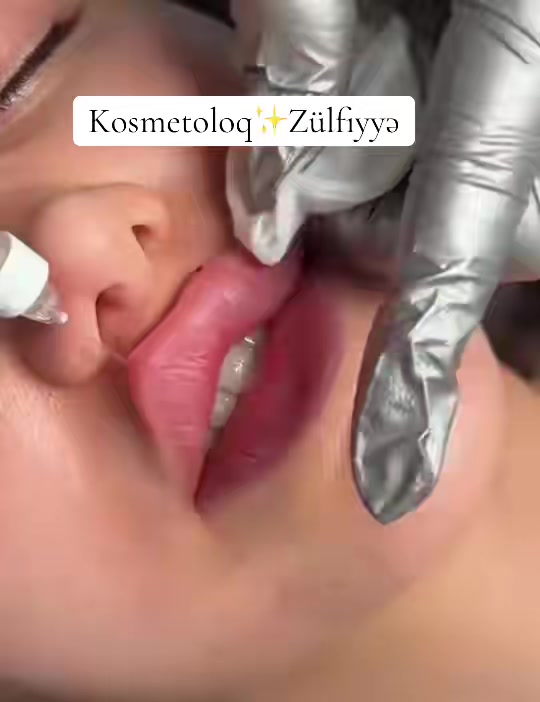 @Xankəndi.Şuşa.💉Kosmetoloq💉