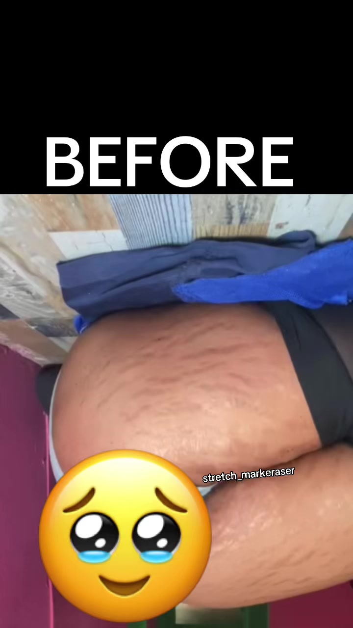 @Stretch_markeraser