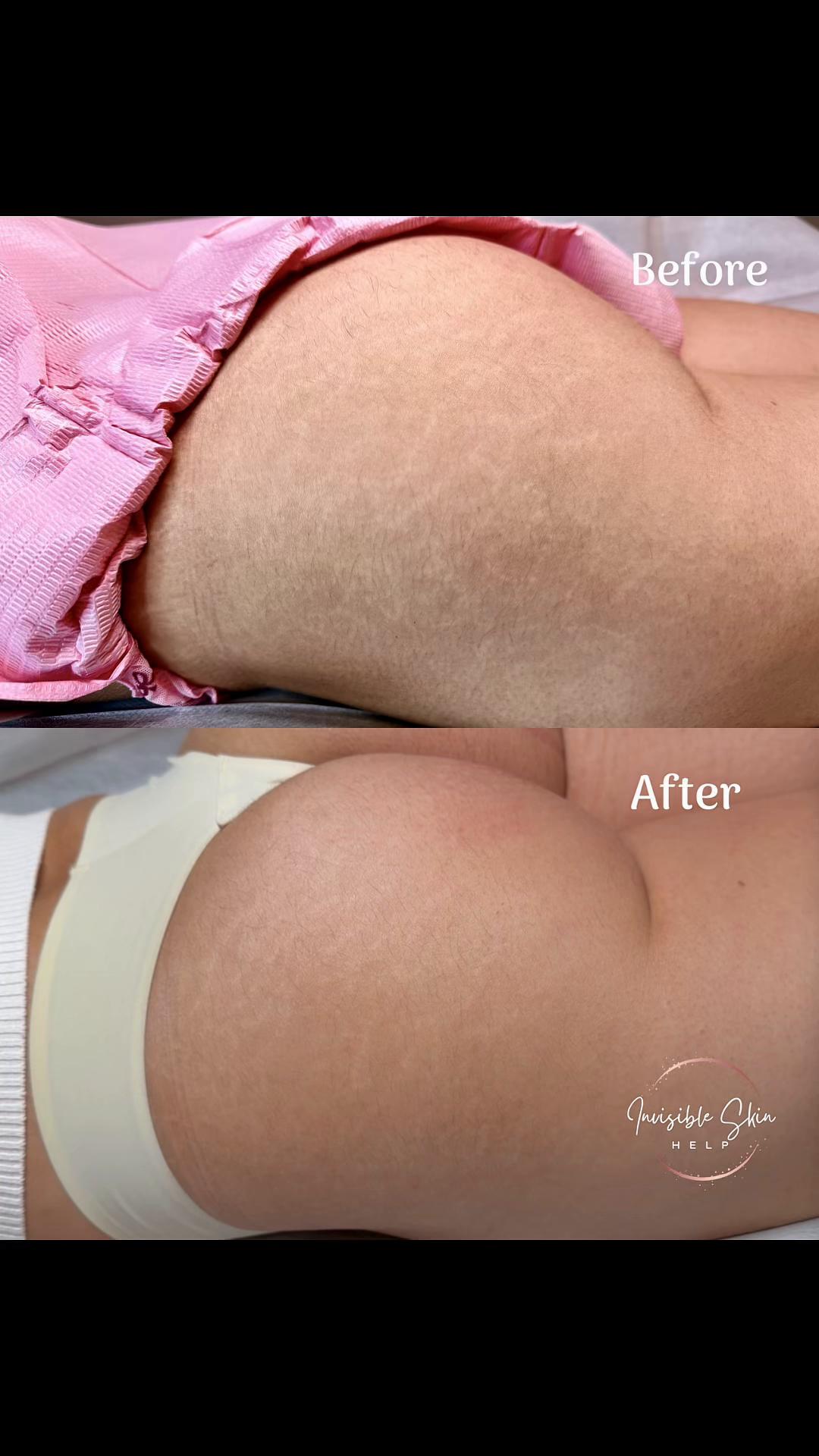 @Invisibleskinhelp