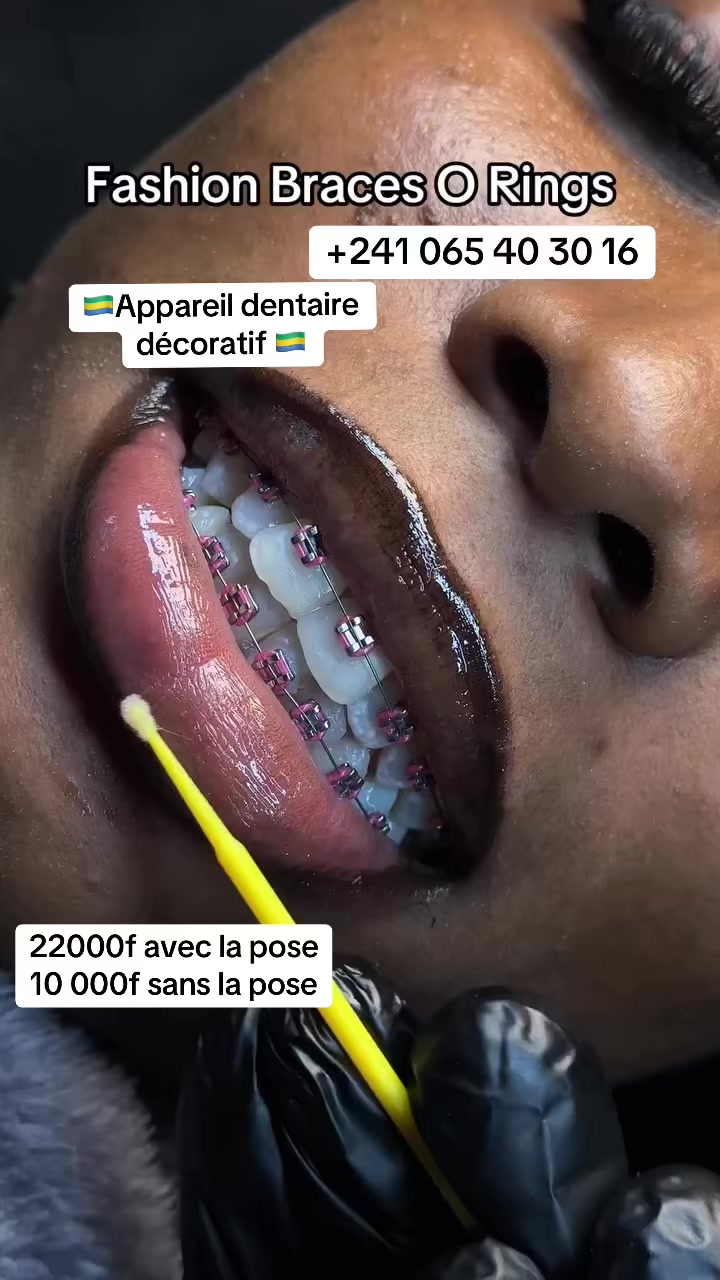 @MG BRACES