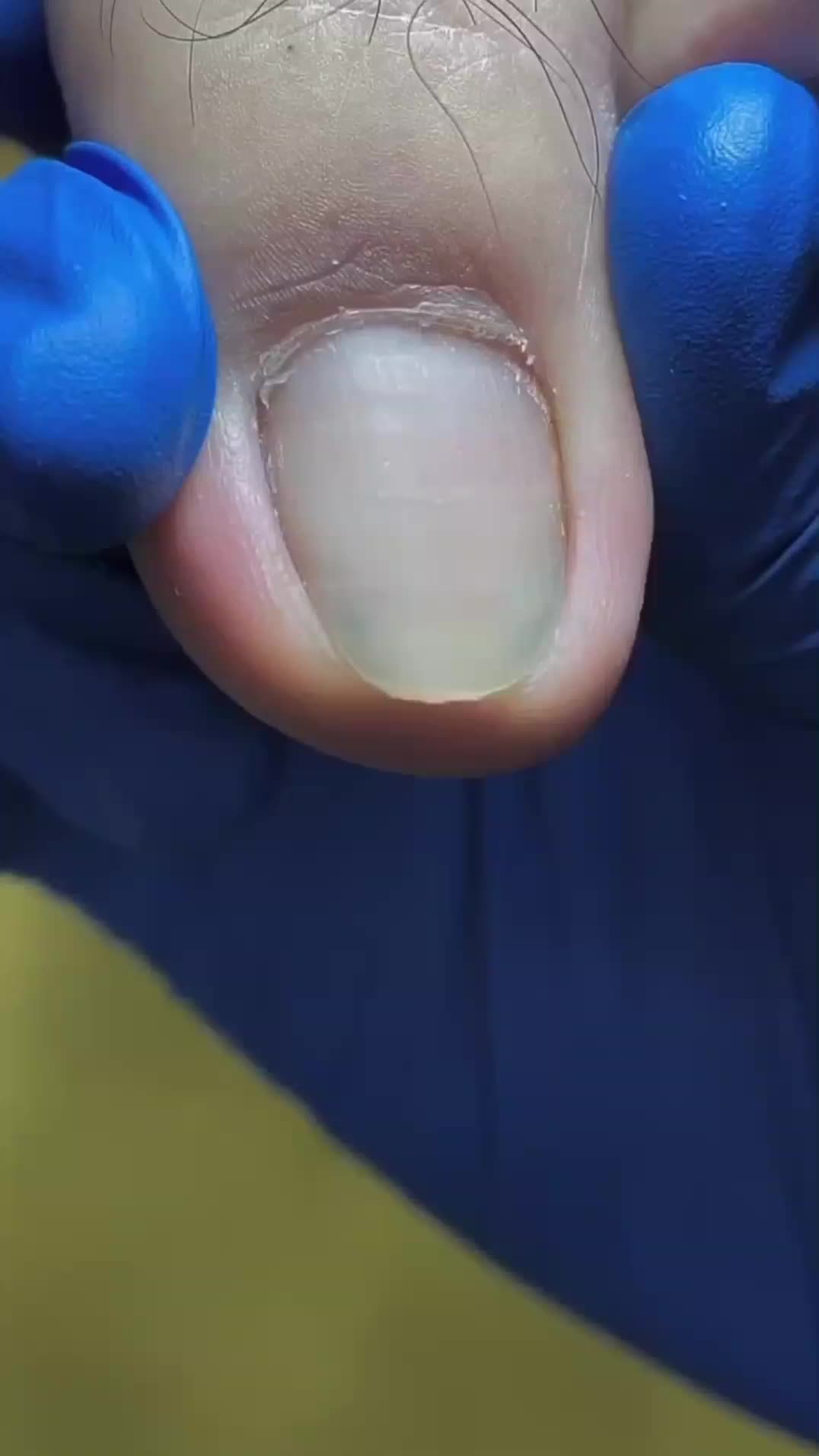 @Pimple Pooping