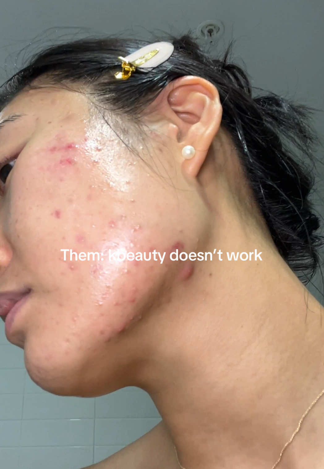 @Lisa | acne &rarr; clear skin