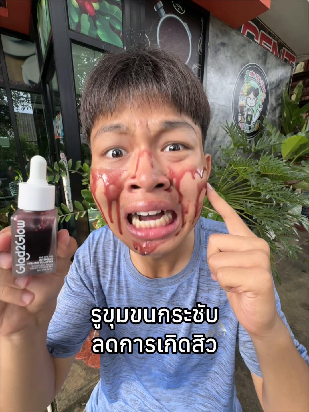 @มิกสิว!