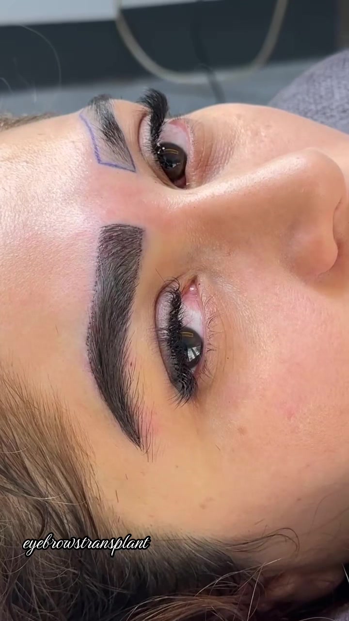 @Eyebrows Transplant