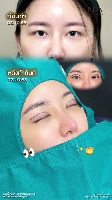 @เวลาคลินิก ตาสองชั้น ถุงใต้ตา