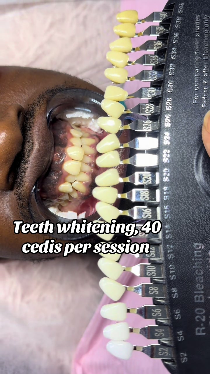 @Teethwhitening—MartGlow Avenue