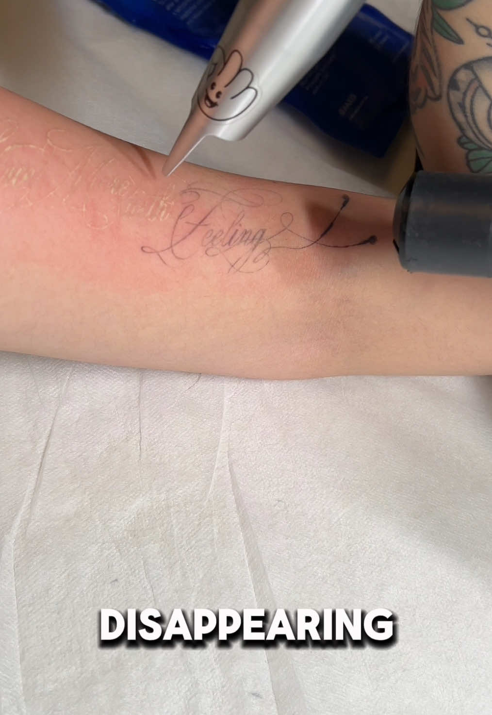 @Swift_tattoo_removal
