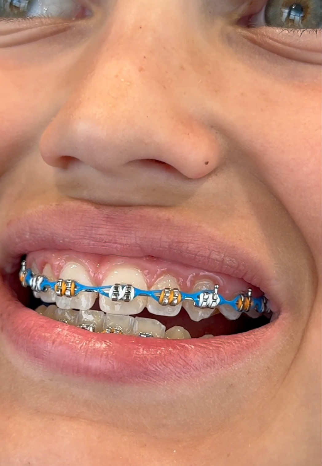 @The Braces Guy