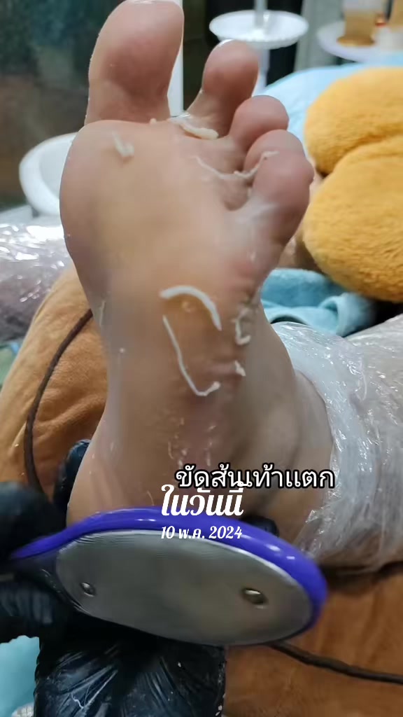 @เล็บขบหาดใหญ่byจิ๊บ