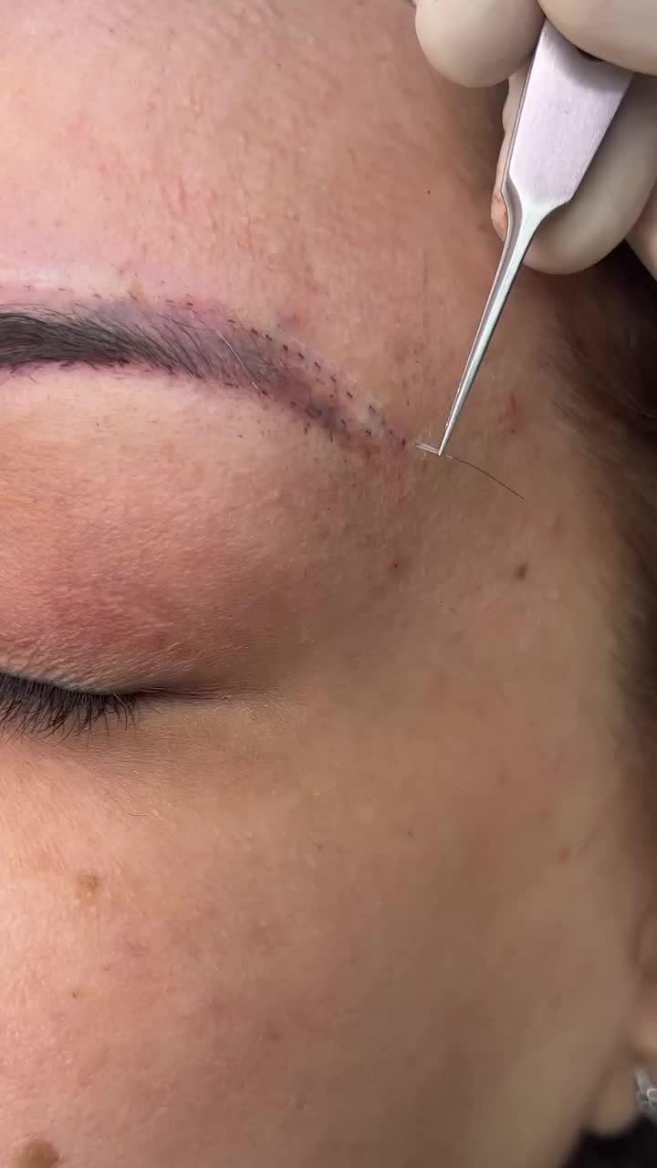 @Eyebrows Transplant