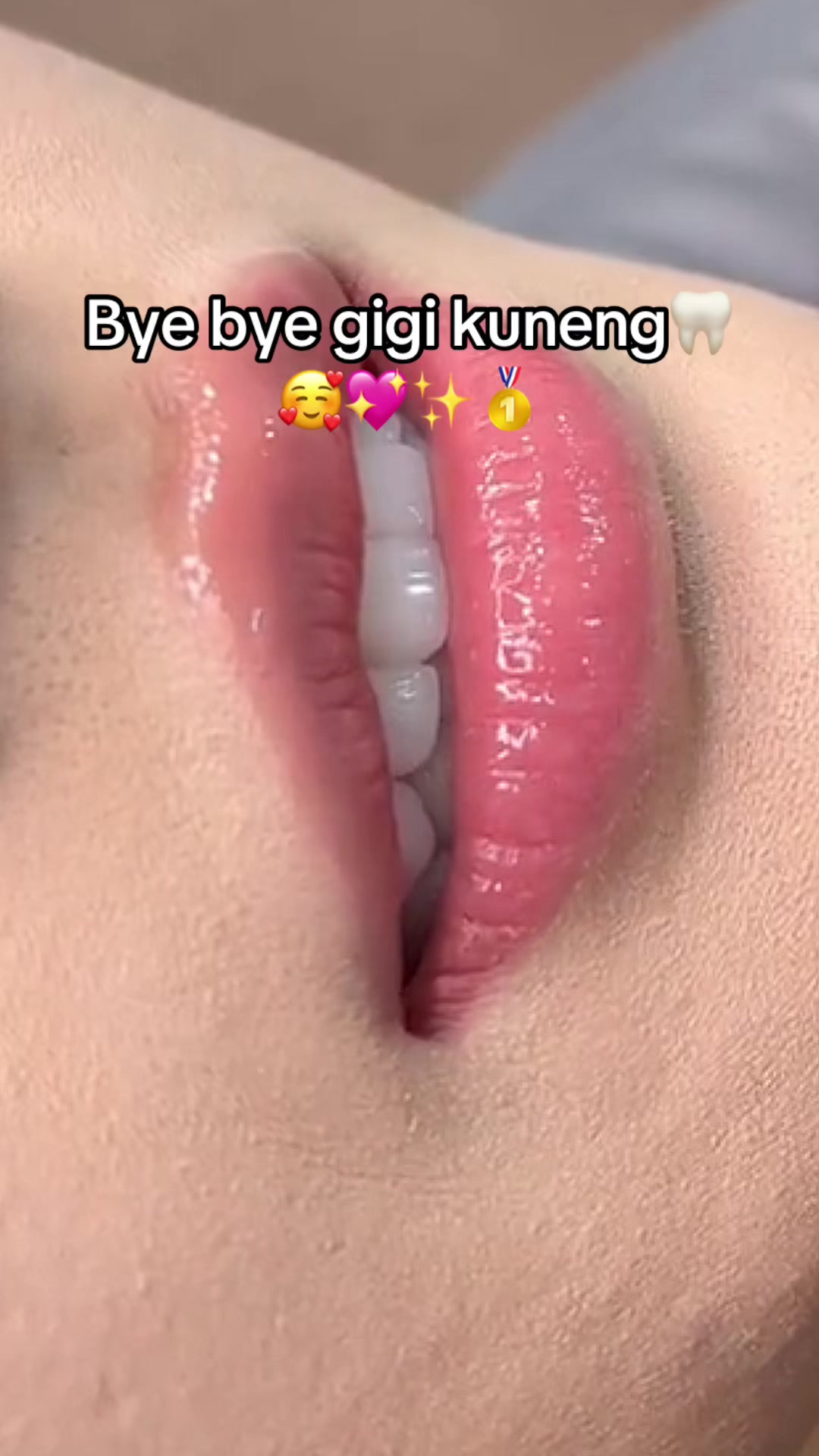 @Gigi Putih Berkilau🦷✨