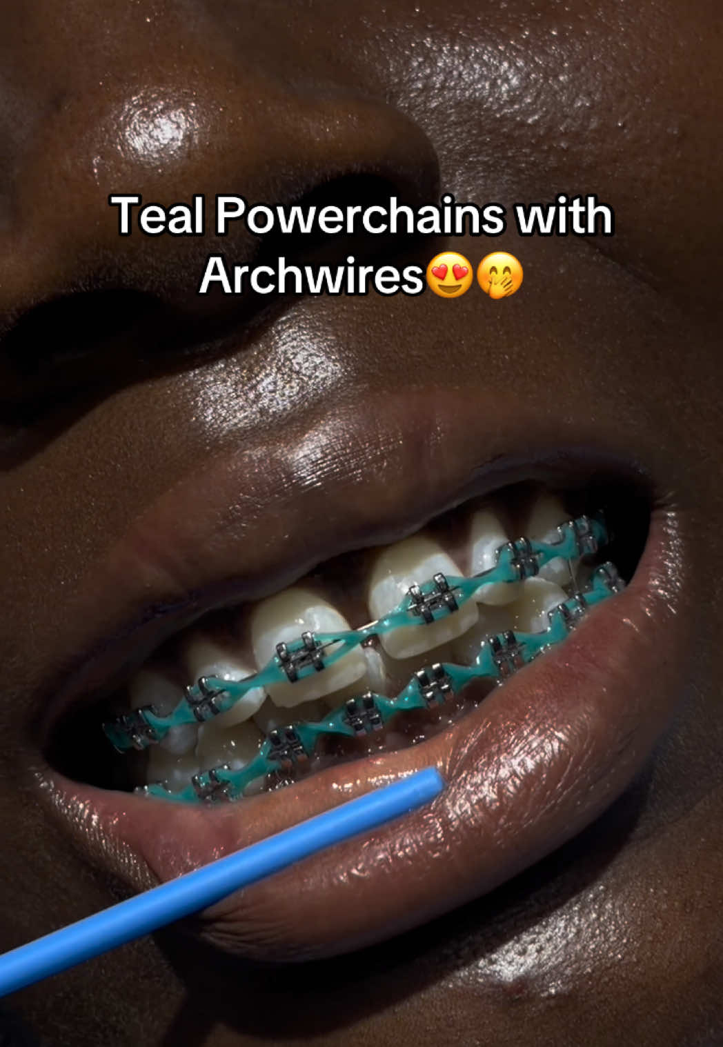 @Abuja Fashion Braces/Toothgems