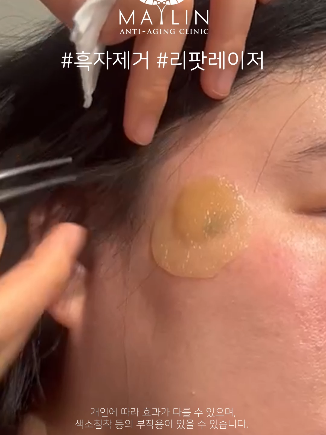 @메이린의원대구점
