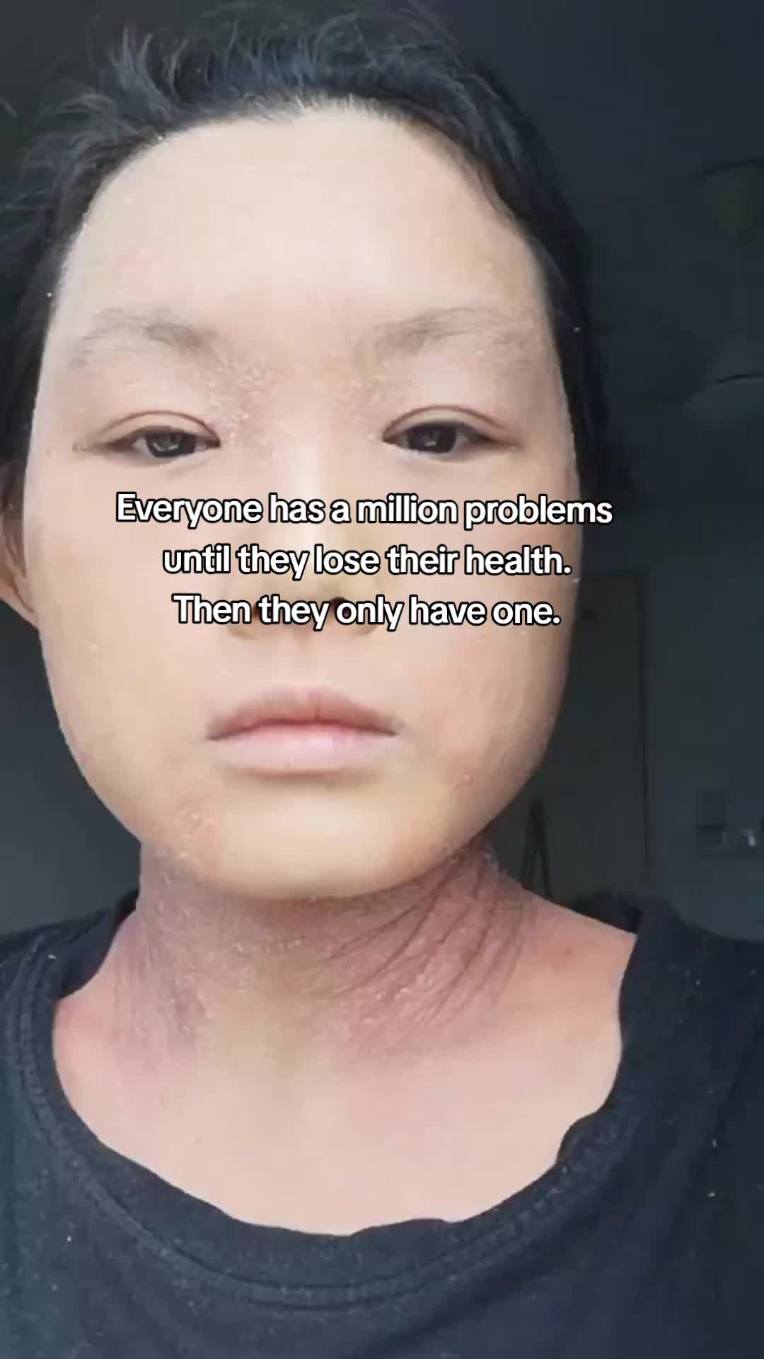 @Grace | TSW & Eczema Recovery