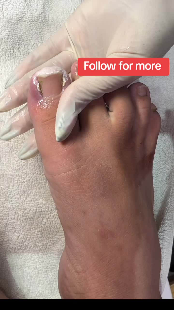@Pimple Pooping