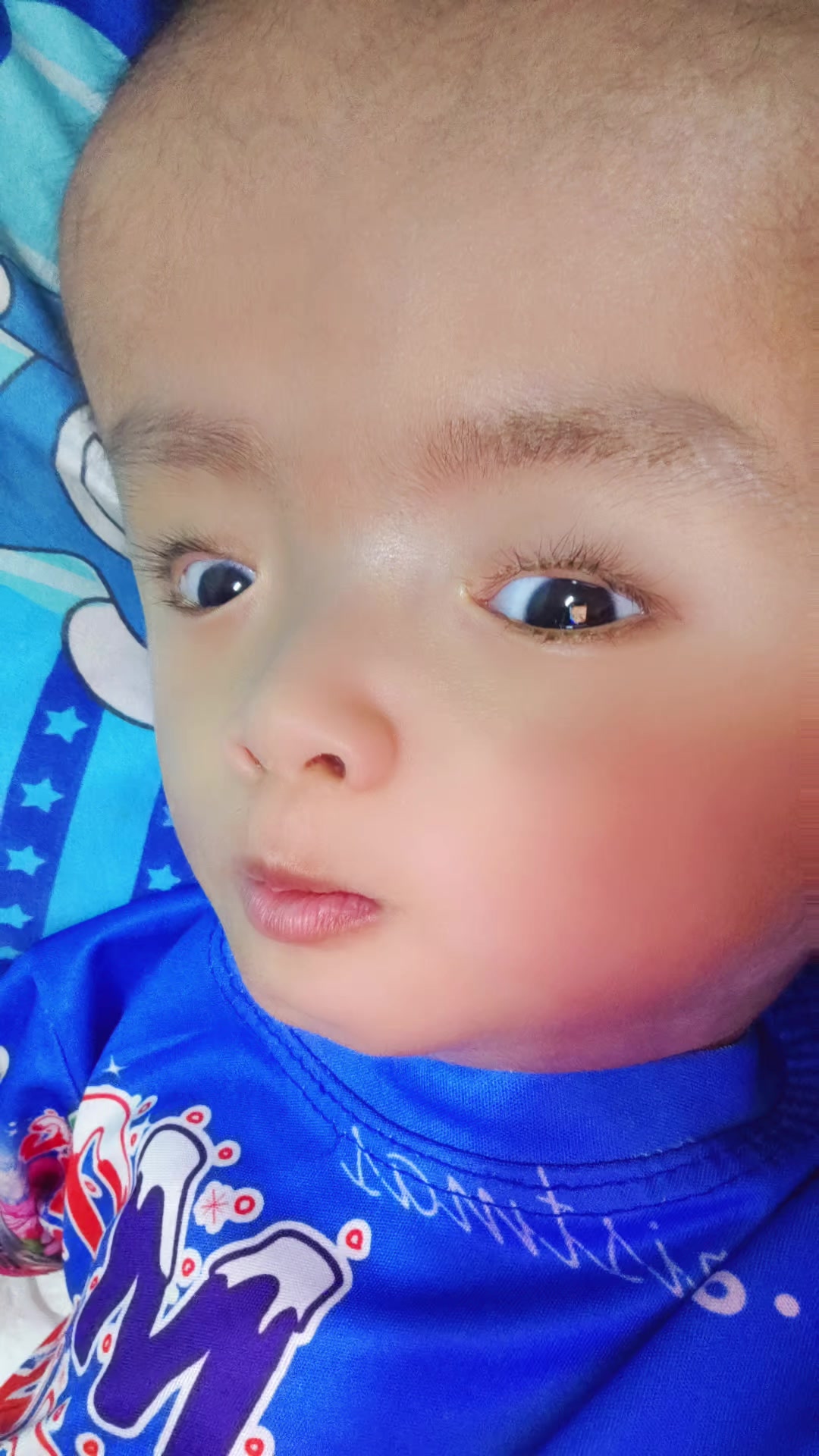 @บู้บี้เด็กหัวโตมีน้ำในโพรงสมอง