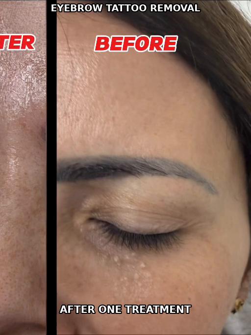 @Zeiva laser /Dearborn MI