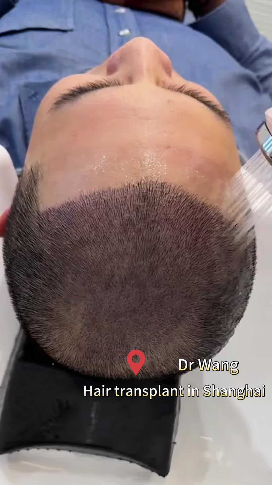 @HAIR TRANSPLANT WANG🇨🇳