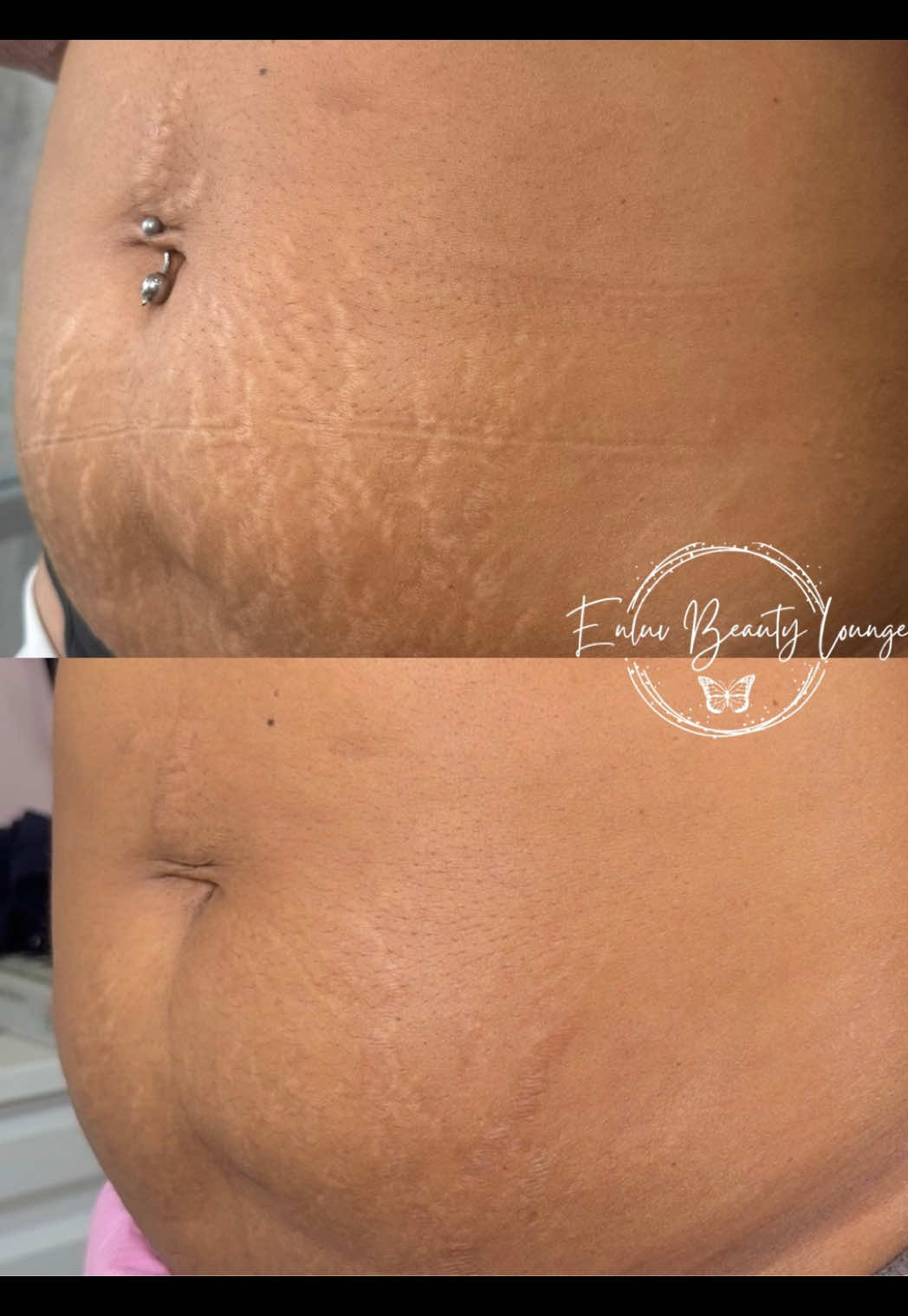 @Stretch Mark Fairy 🧚✨