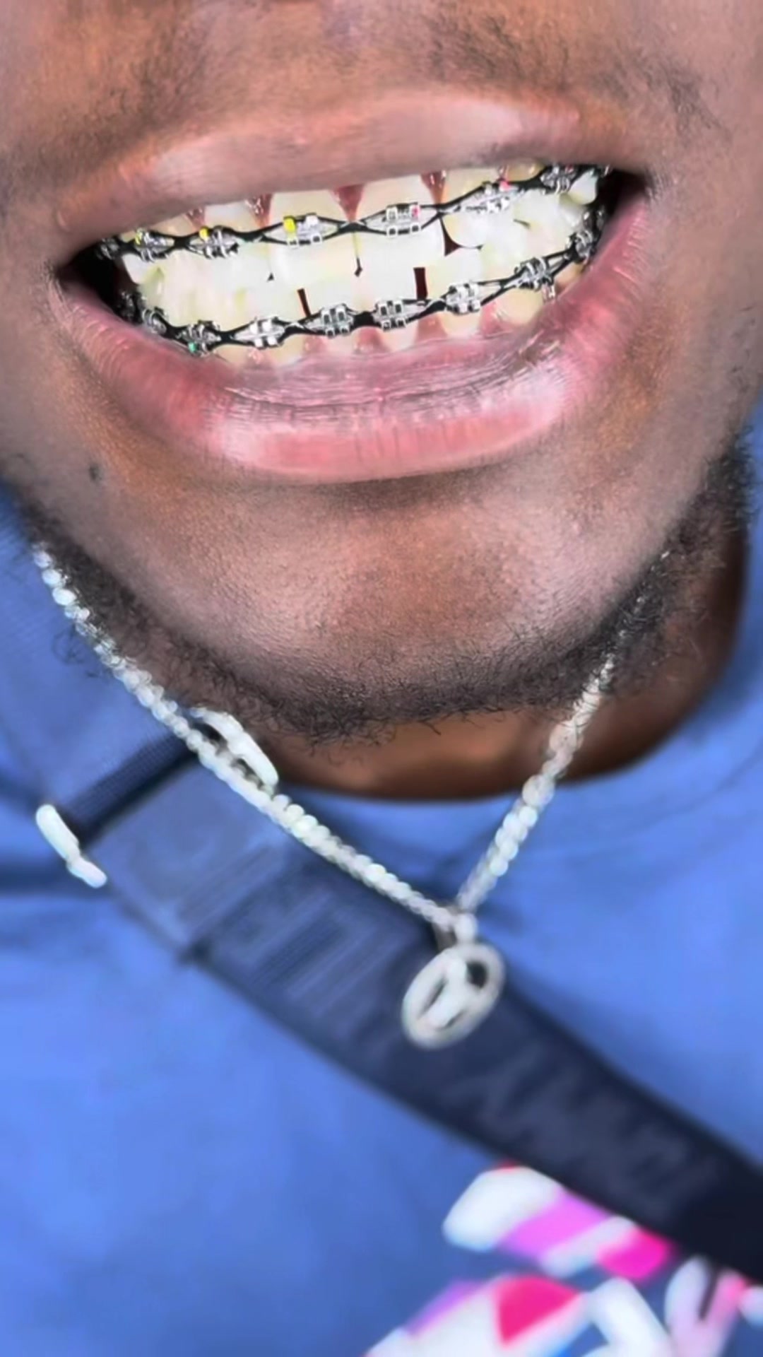 @bracesjunkie