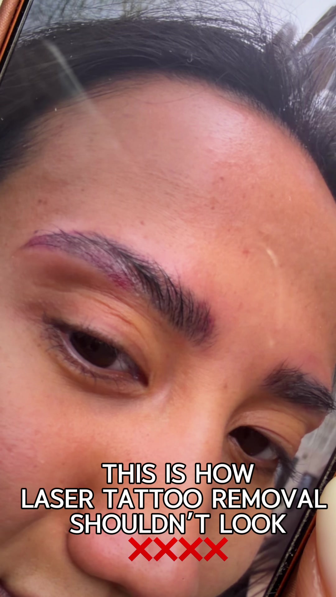 @Safe Eyebrows Tattoo Removal🗽