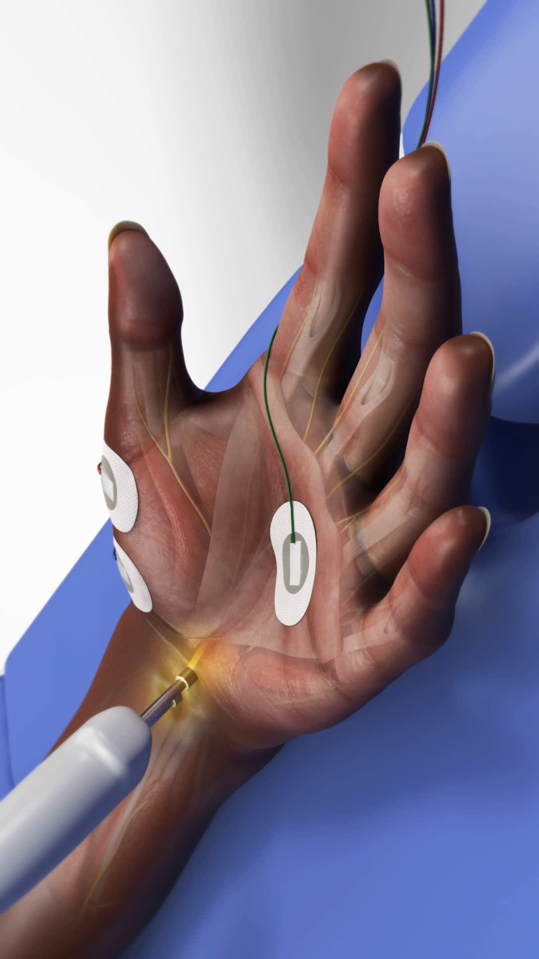@Viz Medical