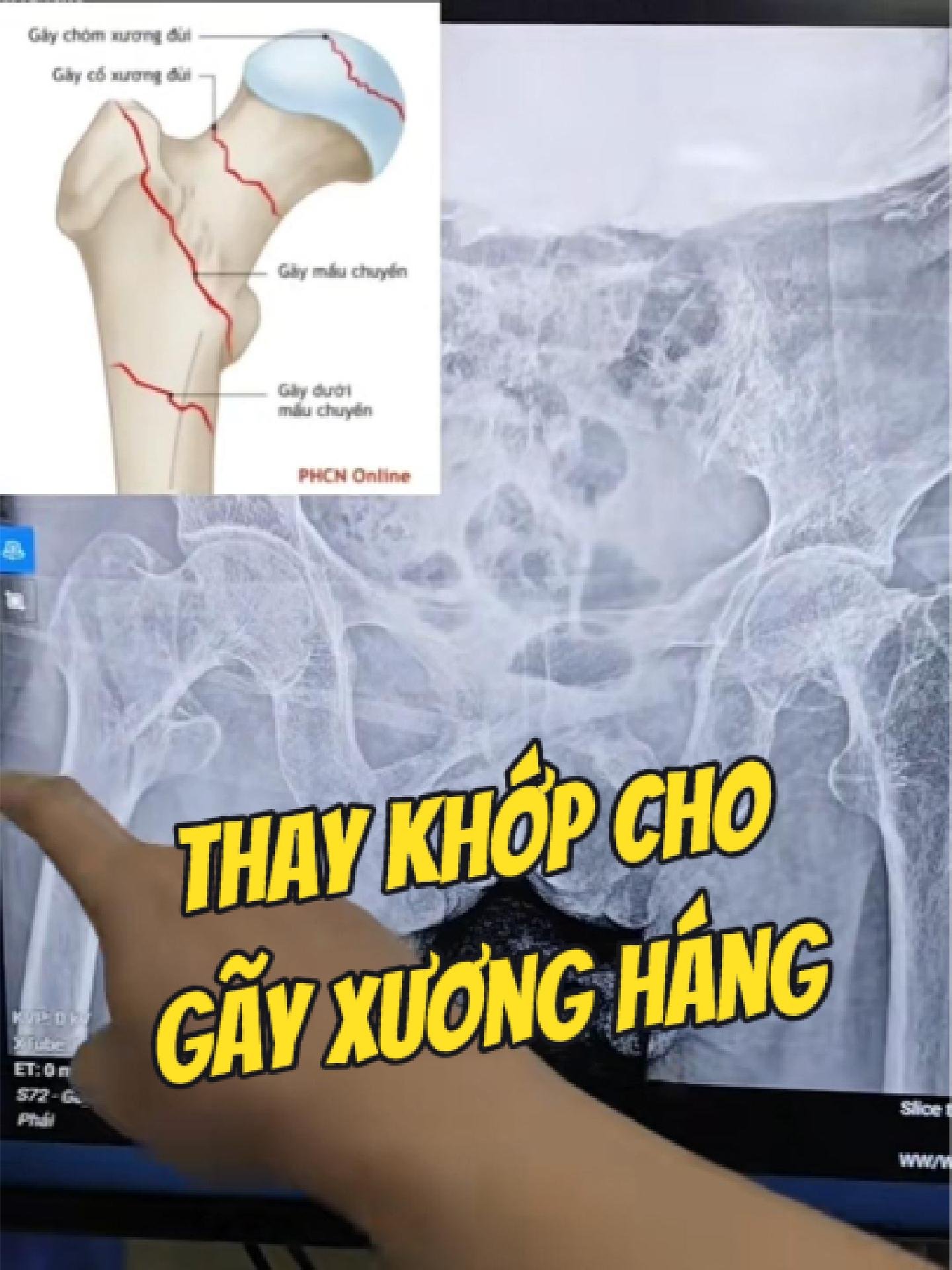 @Chuy&ecirc;n gia xương khớp
