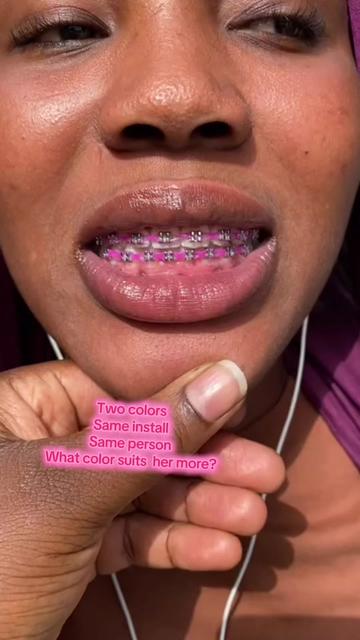 @Braces.bymavi|Smile Aesthetics