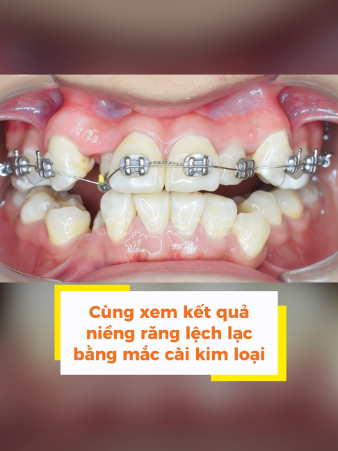 @Nha khoa niềng răng Up Dental